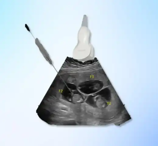 Fetal Reduction